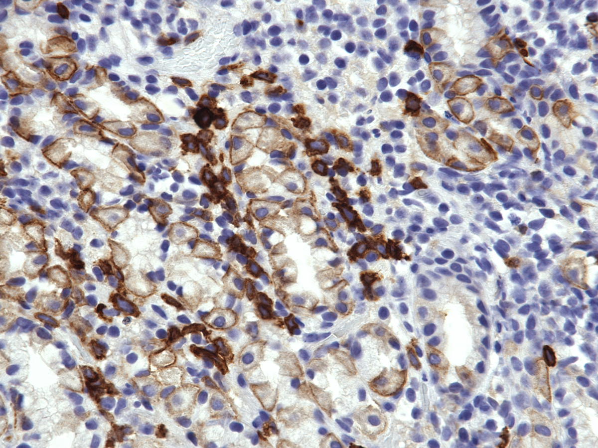 gastric erosion, CD117, 40x, demonstrating clusters of CD117 cells